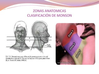 ZONAS ANATOMICAS
CLASIFICACIÓN DE MONSON
 
