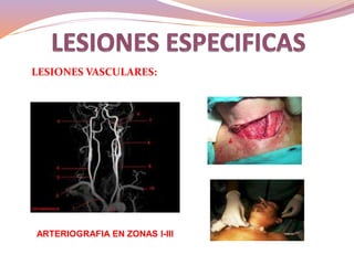 LESIONES VASCULARES: Constituyen la mayor proporción
de las lesiones penetrantes del cuello, la mayoría necesitan
intervención quirúrgica.
ARTERIOGRAFIA EN ZONAS I-III
ESTANDAR DE ORO
 