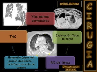 Vías aéreas
permeables
Exploración física
de tórax
RX de tórax
Ecografía (signo del
pulmón deslizante –
artefacto en cola de
cometa
TAC
EVALUACION
INICIAL
KAROL GARCIA
C
I
R
U
G
I
A
 