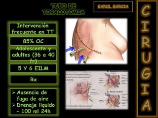 KAROL GARCIA
C
I
R
U
G
I
A
TUBO DE
TORACOTOMIA
Intervención
frecuente en TT
85% OC
Adolescente y
adultos (36 a 40
fr)
5 Y 6 EILM
Rx
Ausencia de
fuga de aire
Drenaje liquido
– 100 ml 24h
 