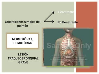 Laceraciones simples del
pulmón
Penetrantes
No Penetrante
NEUMOTÓRAX,
HEMOTÓRAX
LESIÓN
TRAQUEOBRONQUIAL
GRAVE
 
