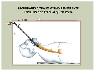 SECUNDARIO A TRAUMATISMO PENETRANTE
LOCALIZARCE EN CUALQUIER ZONA
Derrame Pleural sin fractura costal
Dolor desproporcionado para hallazgos
clínicos
Enfisema Subcutáneo o
neumomediastino sin causa aparente
Presencia de contenido gástrico en tubo
de tórax
 