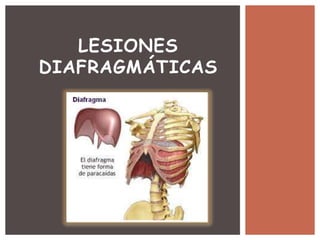 LESIONES
DIAFRAGMÁTICAS
 