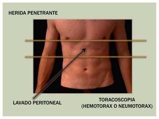 HERIDA PENETRANTE
LAVADO PERITONEAL
TORACOSCOPIA
(HEMOTORAX O NEUMOTORAX)
 