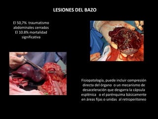 LESIONES DEL BAZO
El 50,7% traumatismo
abdominales cerrados
El 10.8% mortalidad
significativa
Fisiopatología, puede incluir compresión
directa del órgano o un mecanismo de
desaceleración que desgarra la cápsula
esplénica o el parénquima básicamente
en áreas fijas o unidas al retroperitoneo
 