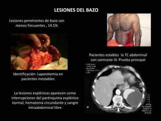 Lesiones penetrantes de bazo son
menos frecuentes , 14.5%
LESIONES DEL BAZO
Identificación: Laparotomía en
pacientes inestables
Pacientes estables la TC abdominal
con contraste IV. Prueba principal
La lesiones esplénicas aparecen como
interrupciones del parénquima esplénico
normal, hematoma circundante y sangre
intraabdominal libre
 