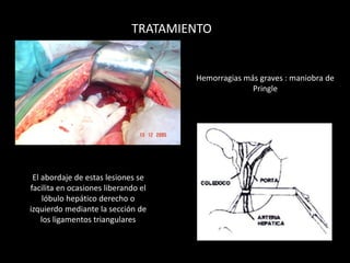 TRATAMIENTO
El abordaje de estas lesiones se
facilita en ocasiones liberando el
lóbulo hepático derecho o
izquierdo mediante la sección de
los ligamentos triangulares
Hemorragias más graves : maniobra de
Pringle
 