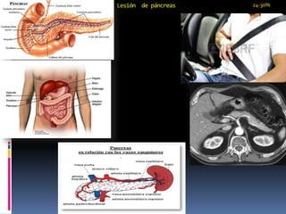 Lesión de páncreas 24-30%
 