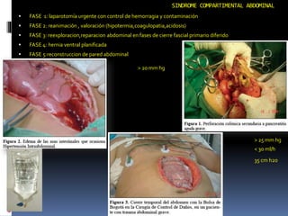 SINDROME COMPARTIMENTAL ABDOMINAL
 FASE 1: laparotomía urgente con control de hemorragia y contaminación
 FASE 2: reanimación , valoración (hipotermia,coagulopatia,acidosis)
 FASE 3: reexploracion,reparacion abdominal en fases de cierre fascial primario diferido
 FASE 4: hernia ventral planificada
 FASE 5:reconstruccion de pared abdominal
> 20 mm hg
> 25 mm hg
35 cm h2o
< 30 ml/h
 