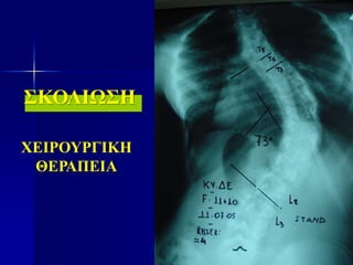 ΣΚΟΛΙΩΣΗ
ΧΕΙΡΟΥΡΓΙΚΗ
ΘΕΡΑΠΕΙΑ
 