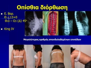 Οπίσθια διόρθωση
Μεγαλύτερος αριθμός σπονδυλοδεμένων επιπέδων
 Ε. Βαρ.
Θ – 13+0
Θ10 – Ο3 (Δ) 45ο
 King IV
 