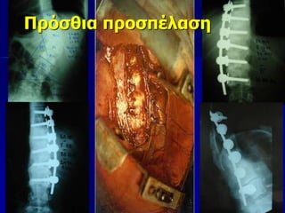 Πρόσθια προσπέλαση
 