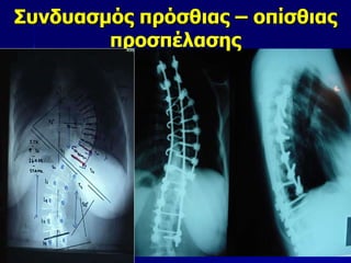 Συνδυασμός πρόσθιας – οπίσθιας
προσπέλασης
 