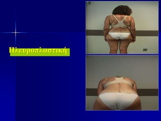 Πλευροπλαστική
 