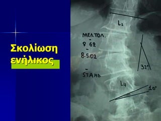 Σκολίωση
ενήλικος
 