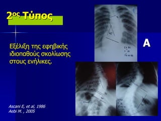 2ος Τύπος
Εξέλιξη της εφηβικής
ιδιοπαθούς σκολίωσης
στους ενήλικες.
Ascani E, et al, 1986
Aebi M. , 2005
A
 
