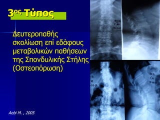 3ος Τύπος
Δευτεροπαθής
σκολίωση επί εδάφους
μεταβολικών παθήσεων
της Σπονδυλικής Στήλης
(Οστεοπόρωση)
Aebi M. , 2005
 