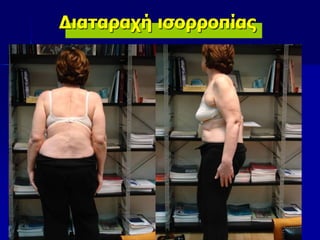 Διαταραχή ισορροπίας
 