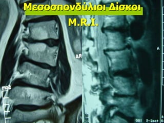 Μεσοσπονδύλιοι Δίσκοι
M.R.I.
 