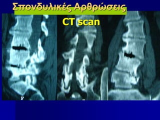 Σπονδυλικές Αρθρώσεις
CT scan
 