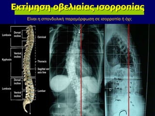 Εκτίμηση οβελιαίας ισορροπίας
Είναι η σπονδυλική παραμόρφωση σε ισορροπία ή όχι;
 