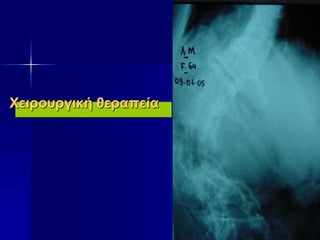 Χειρουργική θεραπεία
 