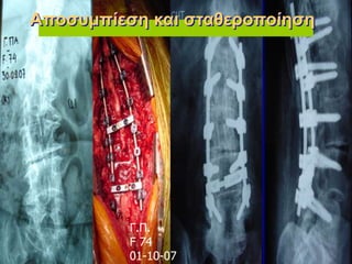 Γ.Π.
F 74
01-10-07
Αποσυμπίεση και σταθεροποίηση
 