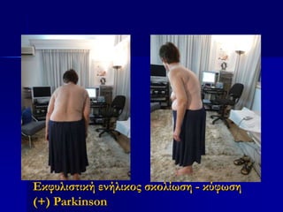 Εκφυλιστική ενήλικος σκολίωση - κύφωση
(+) Parkinson
 