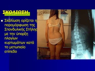 ΣΚΟΛΙΩΣΗ
 Σκολίωση ορίζεται η
παραμόρφωση της
Σπονδυλικής Στήλης
με την ύπαρξη
πλαγίων
κυρτωμάτων κατά
το μετωπιαίο
επίπεδο
 