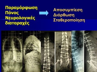 Παραμόρφωση
Πόνος
Νευρολογικές
διαταραχές
Αποσυμπίεση
Διόρθωση
Σταθεροποίηση
 