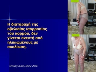 Η διαταραχή της
οβελιαίας ισορροπίας
του κορμού, δεν
γίνεται ανεκτή από
ηλικιωμένους με
σκολίωση.
Timothy Kuklo, Spine 2006
 