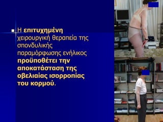  Η επιτυχημένη
χειρουργική θεραπεία της
σπονδυλικής
παραμόρφωσης ενήλικος
προϋποθέτει την
αποκατάσταση της
οβελιαίας ισορροπίας
του κορμού.
 