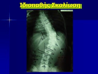 Ιδιοπαθής Σκολίωση
 