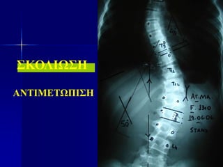 ΣΚΟΛΙΩΣΗ
ΑΝΤΙΜΕΤΩΠΙΣΗ
 