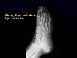 History: 11 year old twisting
injury of the foot
 