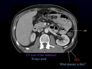 CT scan of the abdomen
X-rays used skin
What density is this?
air
 