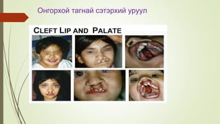 Онгорхой тагнай сэтэрхий уруул
 