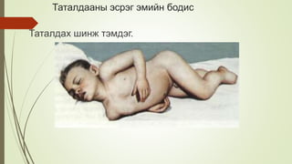 Таталдааны эсрэг эмийн бодис
Таталдах шинж тэмдэг.
 