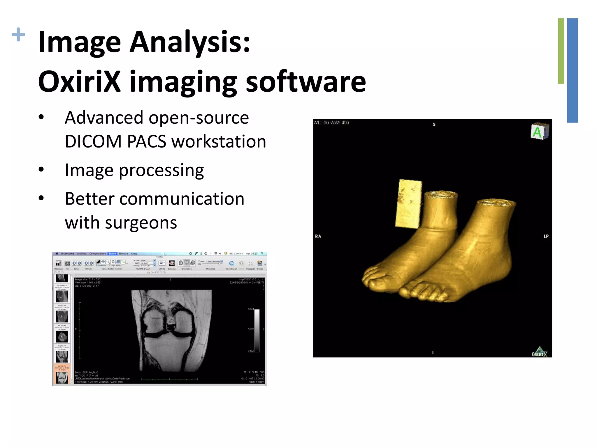 + Image Analysis:
OxiriX imaging software
• Advanced open-source
DICOM PACS workstation
• Image processing
• Better communication
with surgeons
 