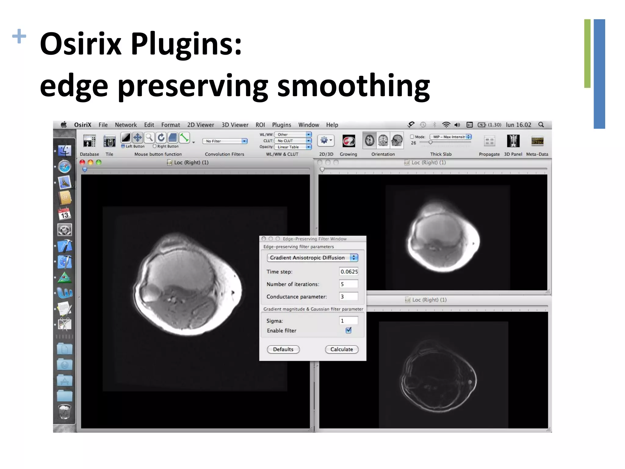 + Osirix Plugins:
edge preserving smoothing
 