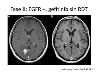 Fase II: EGFR +, gefitinib sin RDT
Iuchi. Lung Cancer 2013;82:282-7
 
