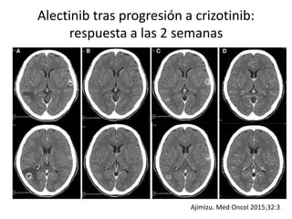 Alectinib tras progresión a crizotinib:
respuesta a las 2 semanas
Ajimizu. Med Oncol 2015;32:3
 