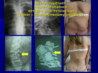 Νευρο-ινωμάτωσηΝευρο-ινωμάτωση
Neuro-fibromatosisNeuro-fibromatosis
αστάθεια μετα-πεταλεκτομήαστάθεια μετα-πεταλεκτομή
(Tumor – Post-laminectomy instability)(Tumor – Post-laminectomy instability)
 