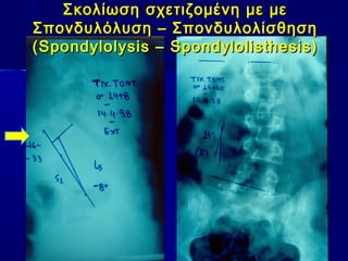 Σκολίωση σχετιζομένη με μεΣκολίωση σχετιζομένη με με
Σπονδυλόλυση – ΣπονδυλολίσθησηΣπονδυλόλυση – Σπονδυλολίσθηση
(Spondylolysis – Spondylolisthesis)(Spondylolysis – Spondylolisthesis)
 