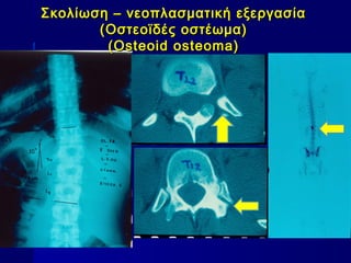 Σκολίωση – νεοπλασματική εξεργασίαΣκολίωση – νεοπλασματική εξεργασία
((OOστεοϊδές οστέωμα)στεοϊδές οστέωμα)
(Osteoid osteoma)(Osteoid osteoma)
 