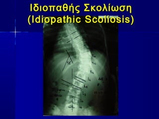 Ιδιοπαθής ΣκολίωσηΙδιοπαθής Σκολίωση
(Idiopathic Scoliosis)(Idiopathic Scoliosis)
 