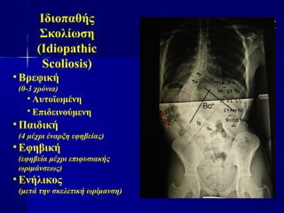 Ιδιοπαθής
Σκολίωση
(Idiopathic
Scoliosis)
• Βρεφική
(0-3 χρόνια)
• Αυτοϊωμένη
• Επιδεινούμενη
• Παιδική
(4 μέχρι έναρξη εφηβείας)
• Εφηβική
(εφηβεία μέχρι επιφυσιακής
ωριμάνσεως)
• Ενήλικος
(μετά την σκελετική ωρίμανση)
 