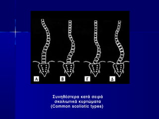 Συνηθέστερα κατά σειρά
σκολιωτικά κυρτώματα
(Common scoliotic types)
 