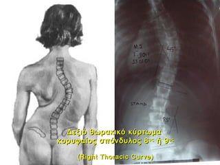 Δεξιό θωρακικό κύρτωμαΔεξιό θωρακικό κύρτωμα
κορυφαίος σπόνδυλος 8κορυφαίος σπόνδυλος 8οςος
ή 9ή 9οςος
(Right Thoracic Curve)(Right Thoracic Curve)
 