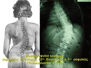 Θωρακοσφυϊκό κύρτωμαΘωρακοσφυϊκό κύρτωμα
κορυφαίος σπόνδυλος 12κορυφαίος σπόνδυλος 12οςος
Θωρακικός ή 1Θωρακικός ή 1οςος
οσφυϊκόςοσφυϊκός
(Thoracolumbar Curve)(Thoracolumbar Curve)
 